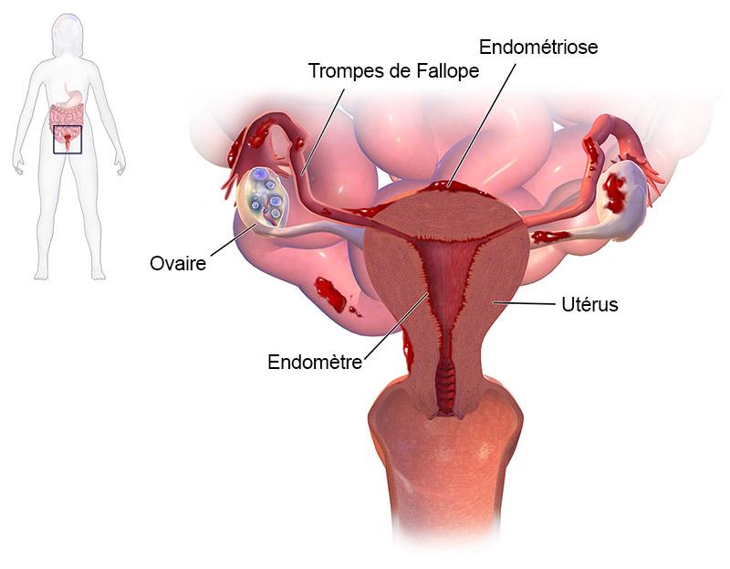 Résultat de recherche d'images pour "endometriose schema"