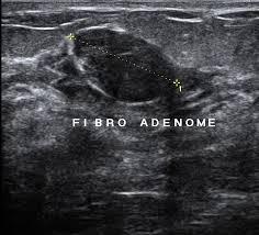 Résultat de recherche d'images pour "adenofibrome mammo"