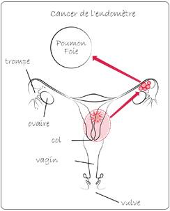 cancer endometre
