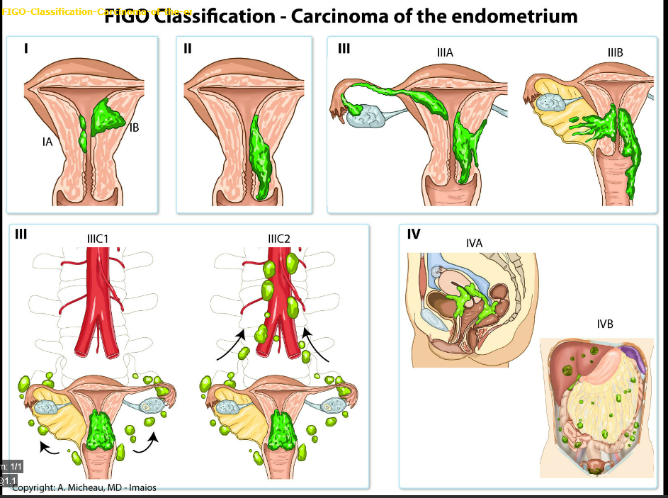 E:\Gyneco-obstétrique\Gynécologie\Image\Classification Figo Endometre.png